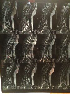 Not a Warhol: MRI cross-sections of my car crash neck.